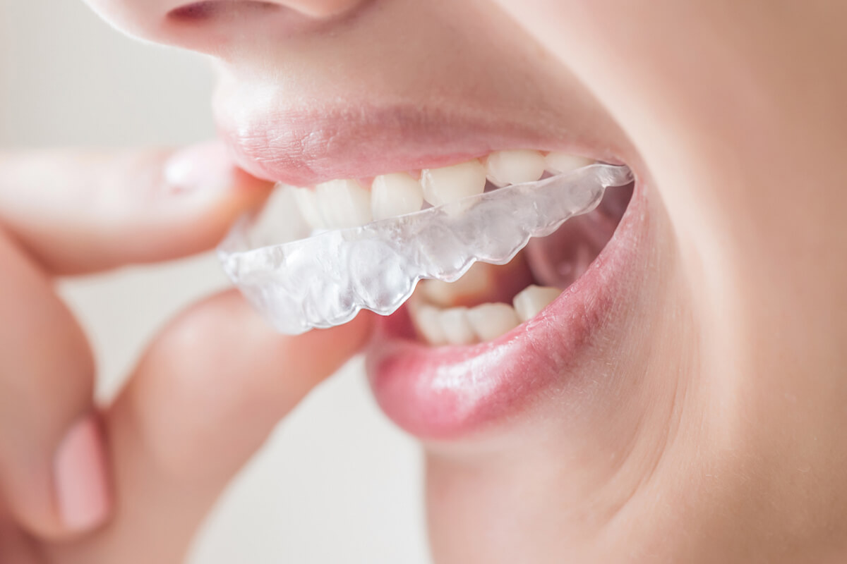 Dental Metal Ceramic Lingual Braces, Invisalign Clear Aligners